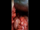 Rectal Cancer Very Low Anterior Resection Of Dexon No Leak ALI ZEDAN MD MRCS