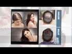 Provillus Hair Loss Treatment for Women & Men