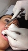 Maggot removal of inside girl's lips