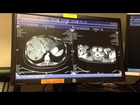 CT SCANS of a Stg 4 Breast Cancer Patient treated with CANNABIS OIL