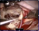 Learn  more about robotic mitral valve repair surgery