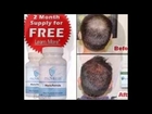Provillus Hair Treatment - Hair Regrowth Products for Men