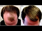 hair baldness remedies - hair baldness treatment - hair regrowth for men