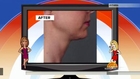 FDA Approves Injection That Can Melt A Double Chin Away